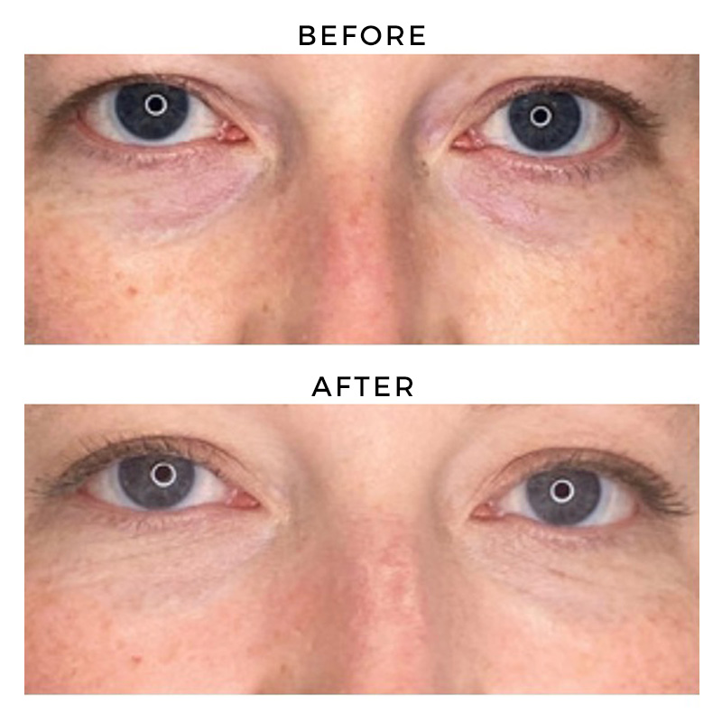 Before and after under eye filler