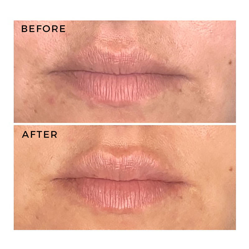 Before and after lip filler treatment.