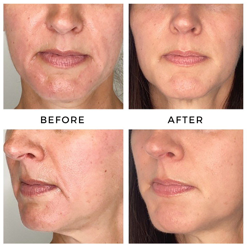 Before and after injectable hyaluronic acid facial filler treatment.
