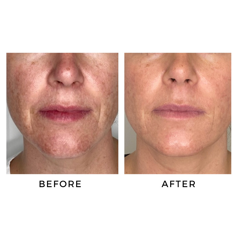 Before and after skincare products and facial filler treatment at glo MD Aesthetics and Wellness.